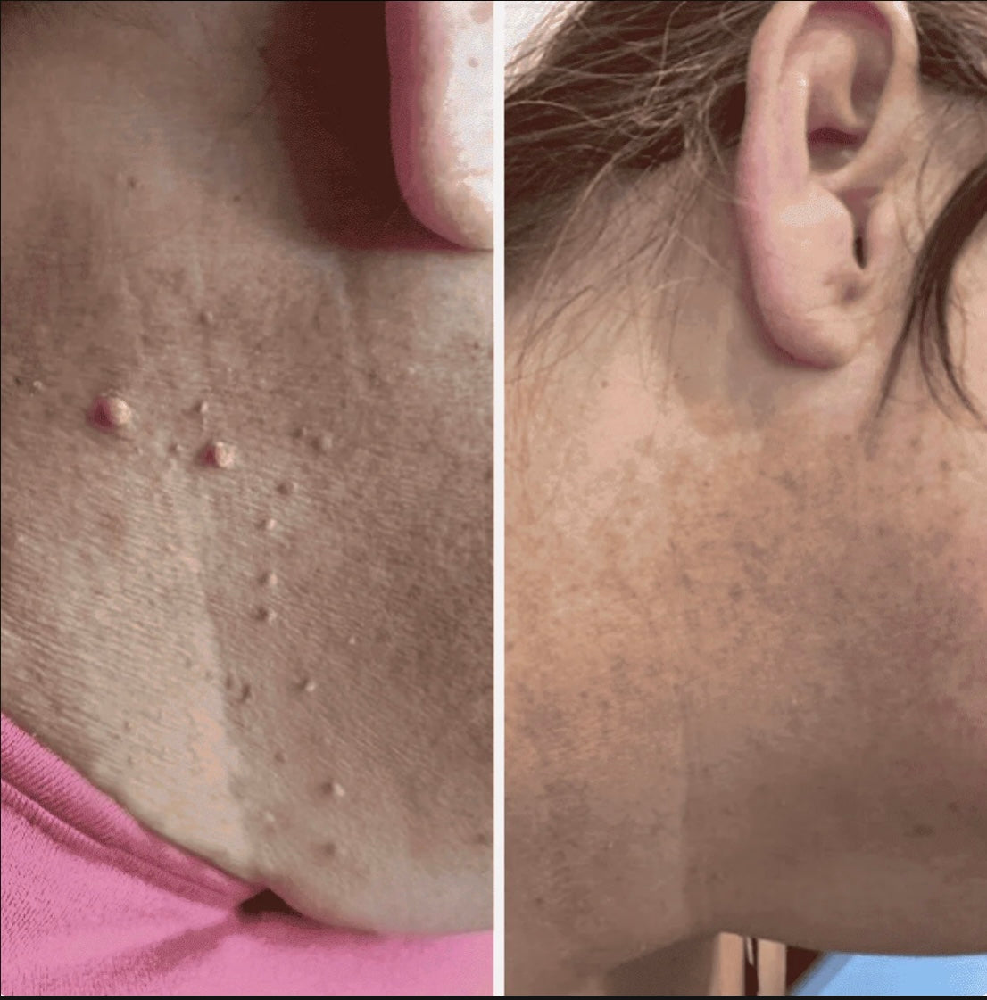 Dermly eliminador de Acrocordones con aplicador de bandas - Fácil y preciso