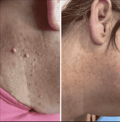 Dermly eliminador de Acrocordones con aplicador de bandas - Fácil y preciso