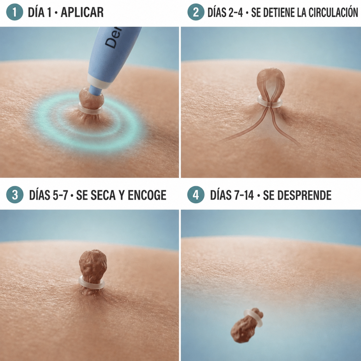 Dermly eliminador de Acrocordones con aplicador de bandas - Fácil y preciso